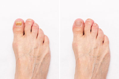 Laser Therapy for Fungal Nails