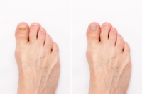 Causes and Treatment of Toenail Fungus