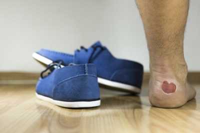 Heel bleeding from shoes on sale