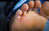Differences Between Foot Corns and Calluses