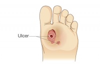 Different Types of Diabetic Foot Ulcers