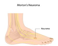 Symptoms and Causes of Morton’s Neuroma