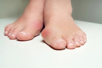 Identifying Signs of a Bunion