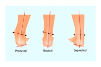 How Overpronation Can Affect the Feet