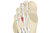 Causes and Treatment of Morton’s Neuroma