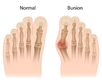 Causes and Treatment for Bunions