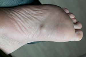 How Plantar Fibromatosis Affects the Foot